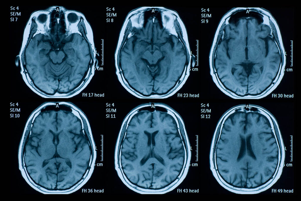 Six MRI scans of a person's head